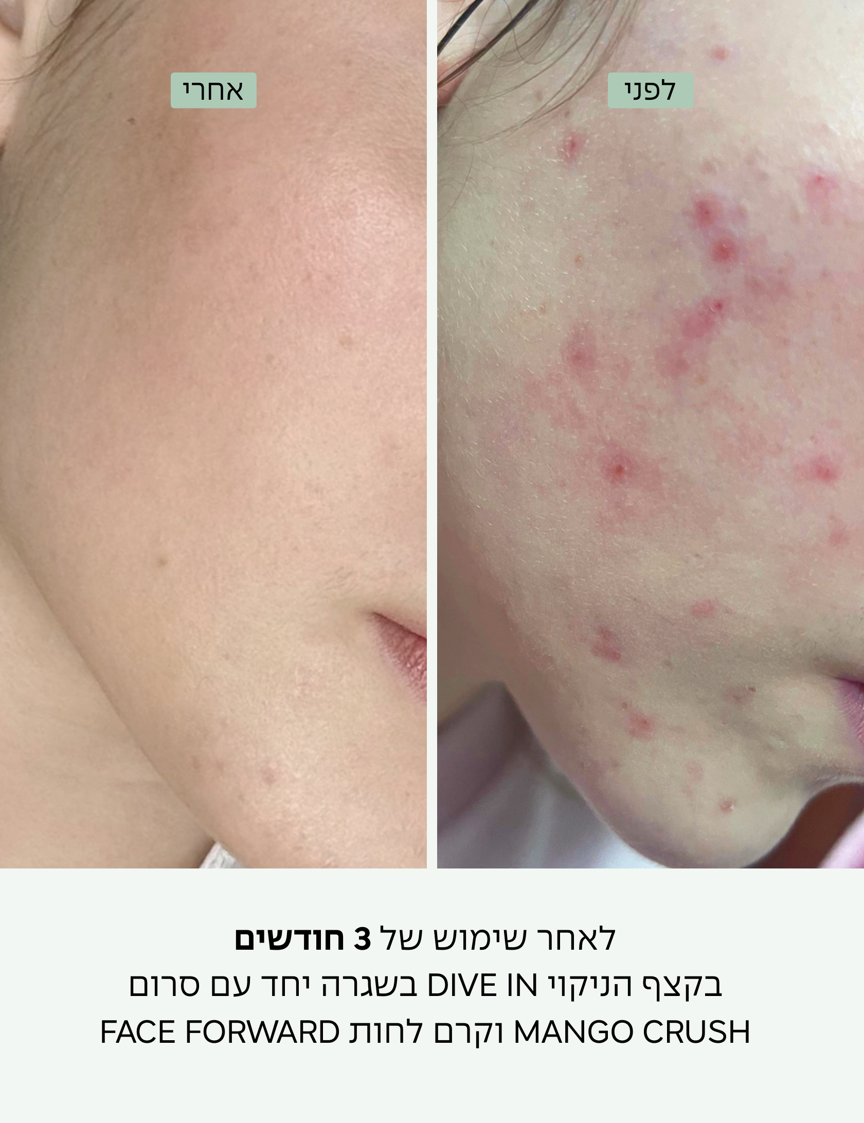לפני ואחרי שימוש בקצף Dive In - הפחתת פצעונים ונקבוביות