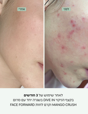 לפני ואחרי שימוש בקצף Dive In - הפחתת פצעונים ונקבוביות