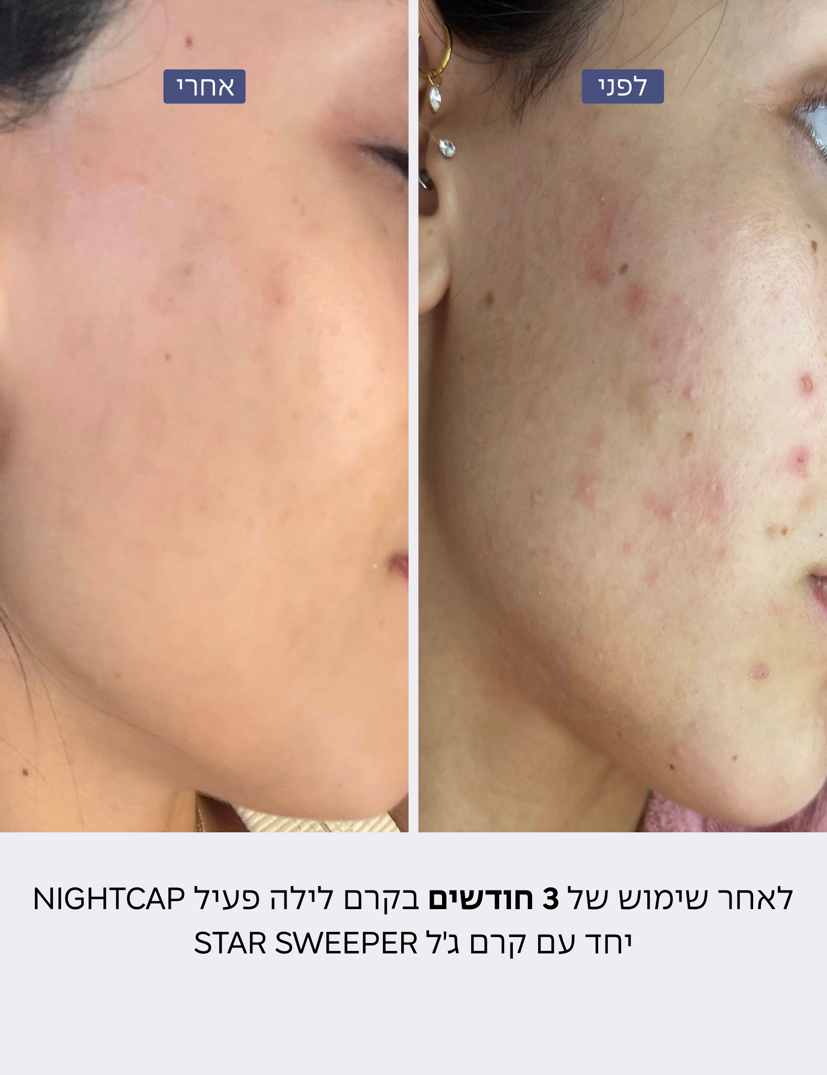 לפני ואחרי שימוש בקרם לילה Nightcap - קמטוטים ופיגמנטציה