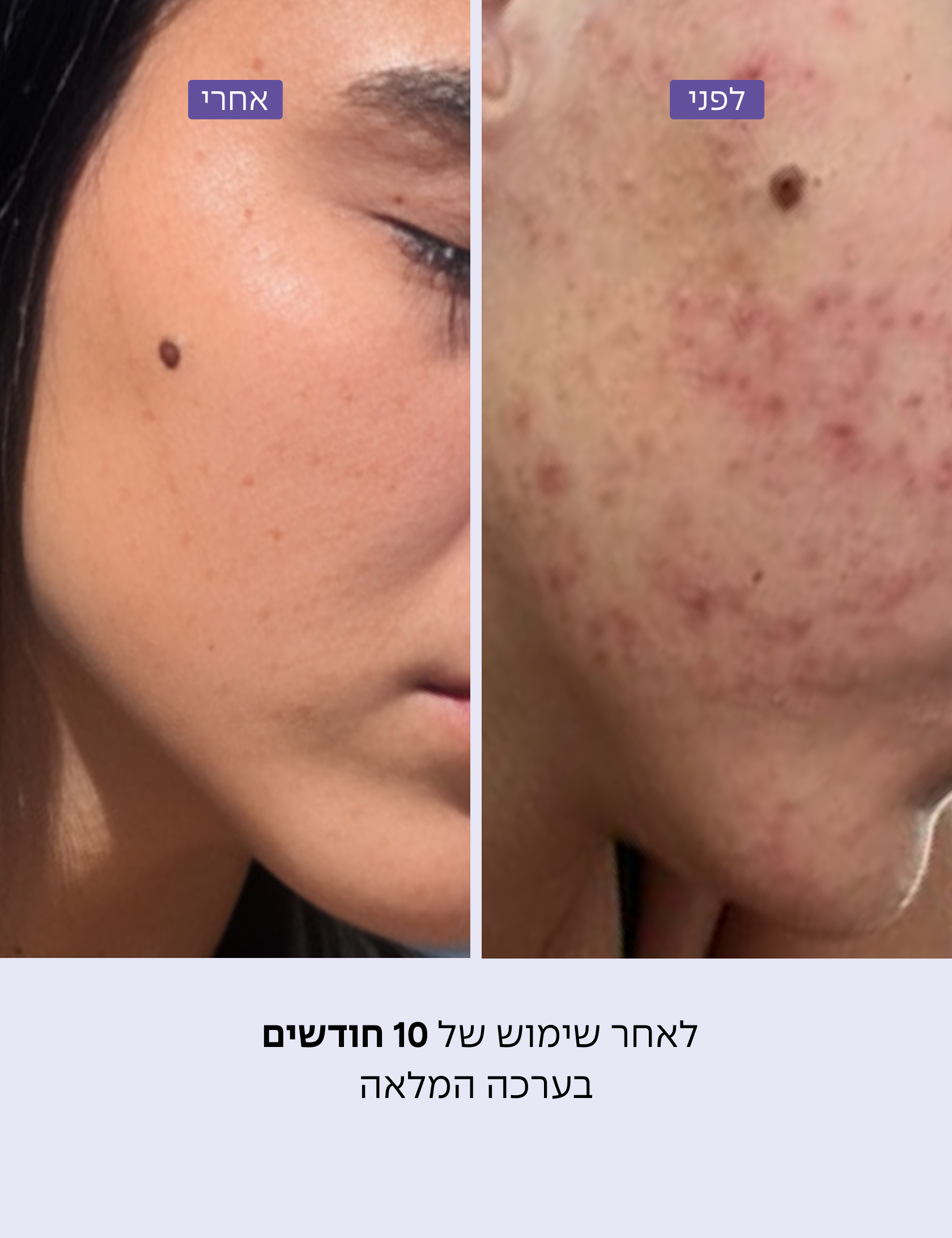 ערכה לעור נוטה לפצעונים